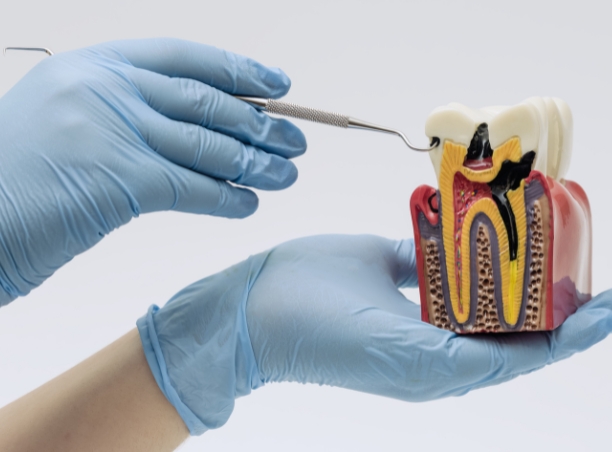 Modello anatomico del dente utilizzato per spiegare gli interventi di chirurgia dentale