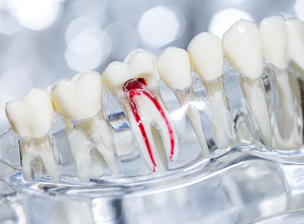 Model dentar transparent cu sistemul de canale radiculare evidențiat