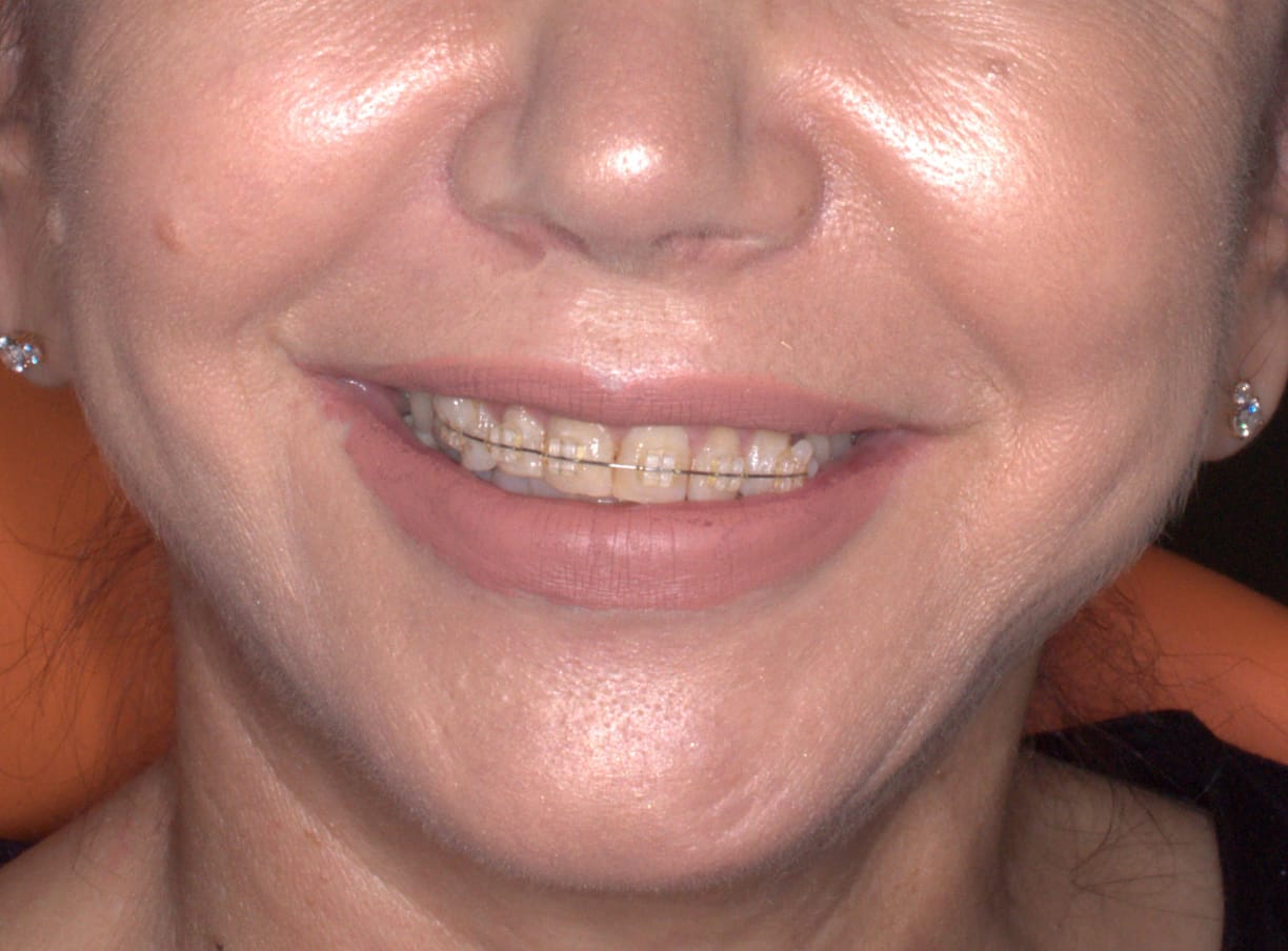 Brackets fijos estéticos, con brackets del tono de los dientes, en un paciente adulto
