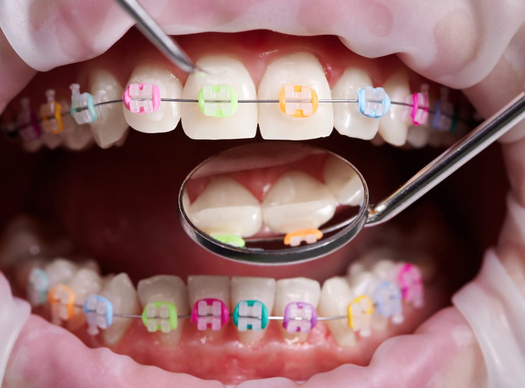 Aparat dentar fix cu ligaturi colorate, verificat cu oglinda stomatologică