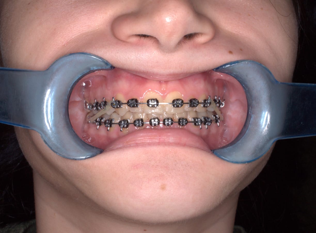 Brackets metálicos fijos en ambas arcadas, durante tratamiento de ortodoncia en Atelierul de Zâmbete