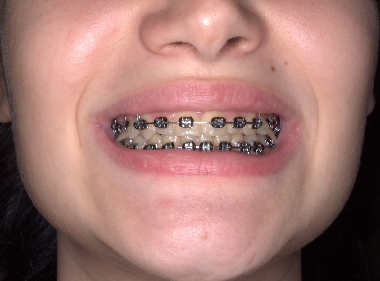 Sonrisa con brackets metálicos fijos, tratamiento de ortodoncia en Sector 3, București